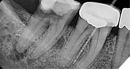 Case 3 by Dr. Mahmood Reza Kalantar Motamedi. (Restoration by Dr. Pardis Doosti)