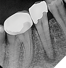 Case 3 by Dr. Mahmood Reza Kalantar Motamedi. (Restoration by Dr. Pardis Doosti)