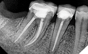The Lateral Puff in Endodontics: Clinically Significant or a ...