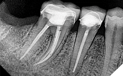 Case 3 by Dr. Mahmood Reza Kalantar Motamedi. (Restoration by Dr. Pardis Doosti)