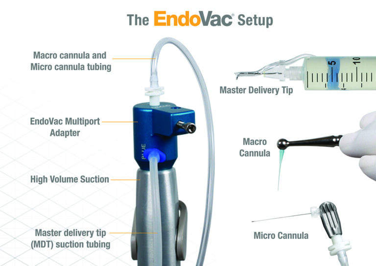 The Master Delivery Tip (MDT) accommodates different sizes of syringes filled with irrigant, the macro cannula is attached to the autoclavable aluminium hand piece and the micro cannula is attached to an autoclavable aluminium finger piece. The macro cannula, the micro cannula and the MDT are connected via clear plastic tubing. The tubes are connected to the high volume suction of the dental chair via the Multi-Port Adaptor.