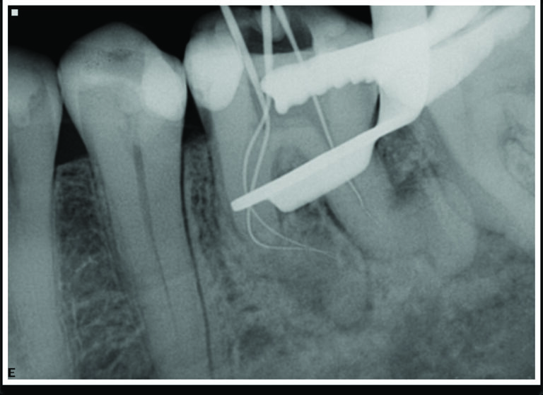 Working radiograph with hand files only negotiating coronal half
of root canal and inability to get to the apices.