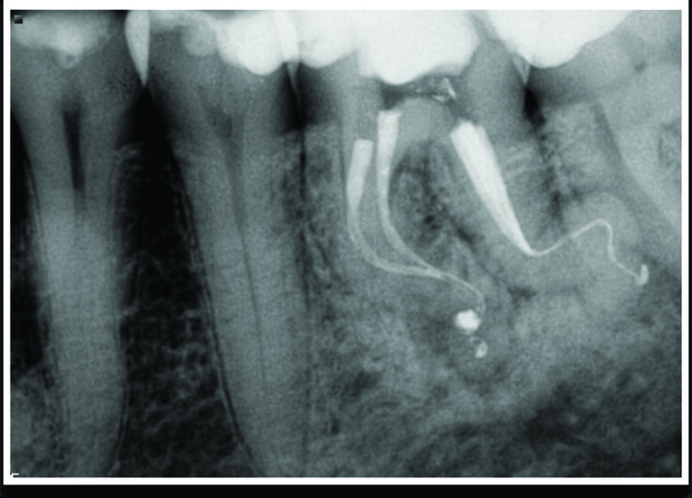 Obturation radiograph revealing
complete fill of the root canals to their respective apices.