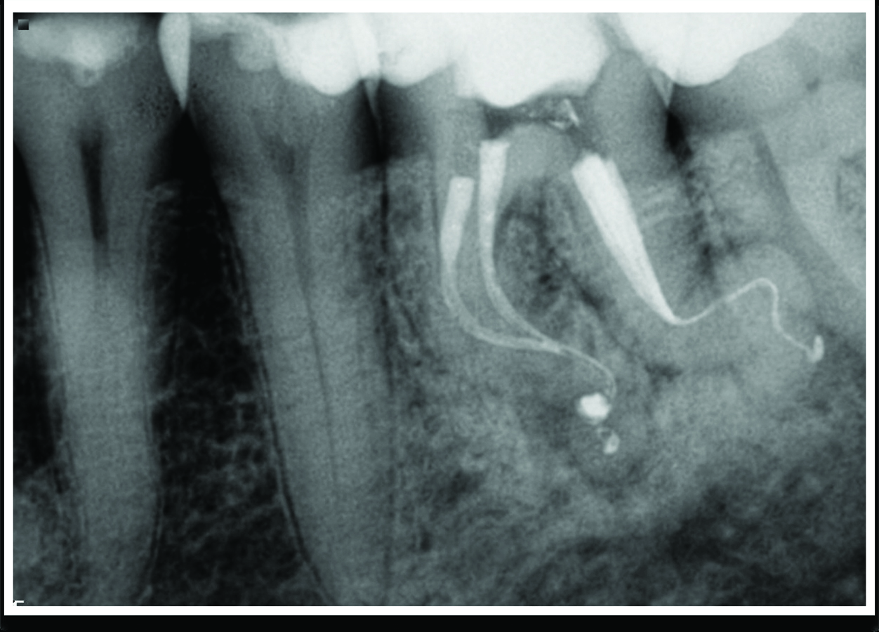 Safe and Effective 3D Endodontic Disinfection Laser Assisted