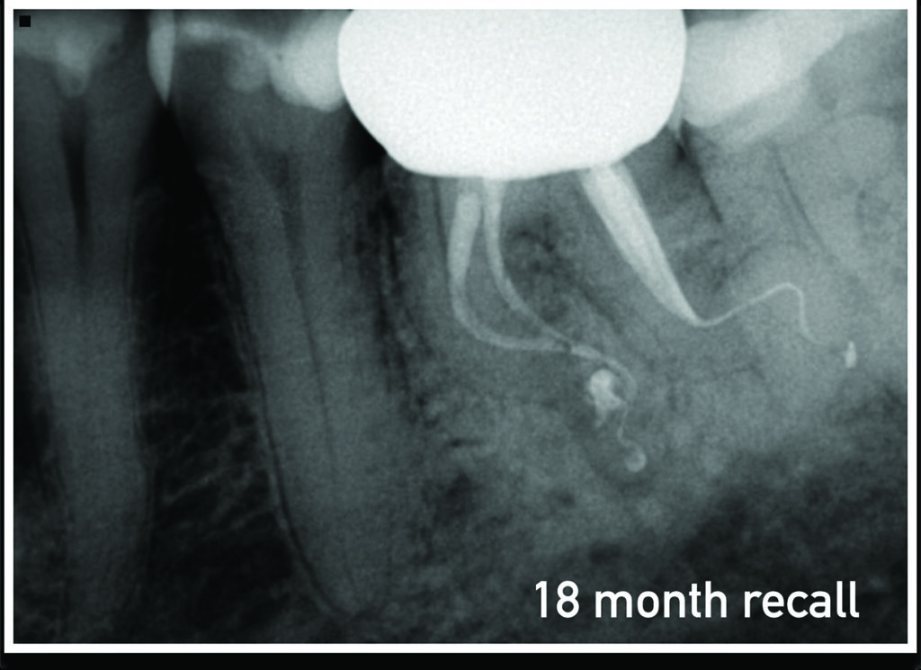 Safe and Effective 3D Endodontic Disinfection Laser Assisted