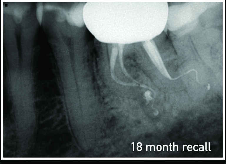 18 month re-assessment radiograph showing healing of the peri-radicular lesion.