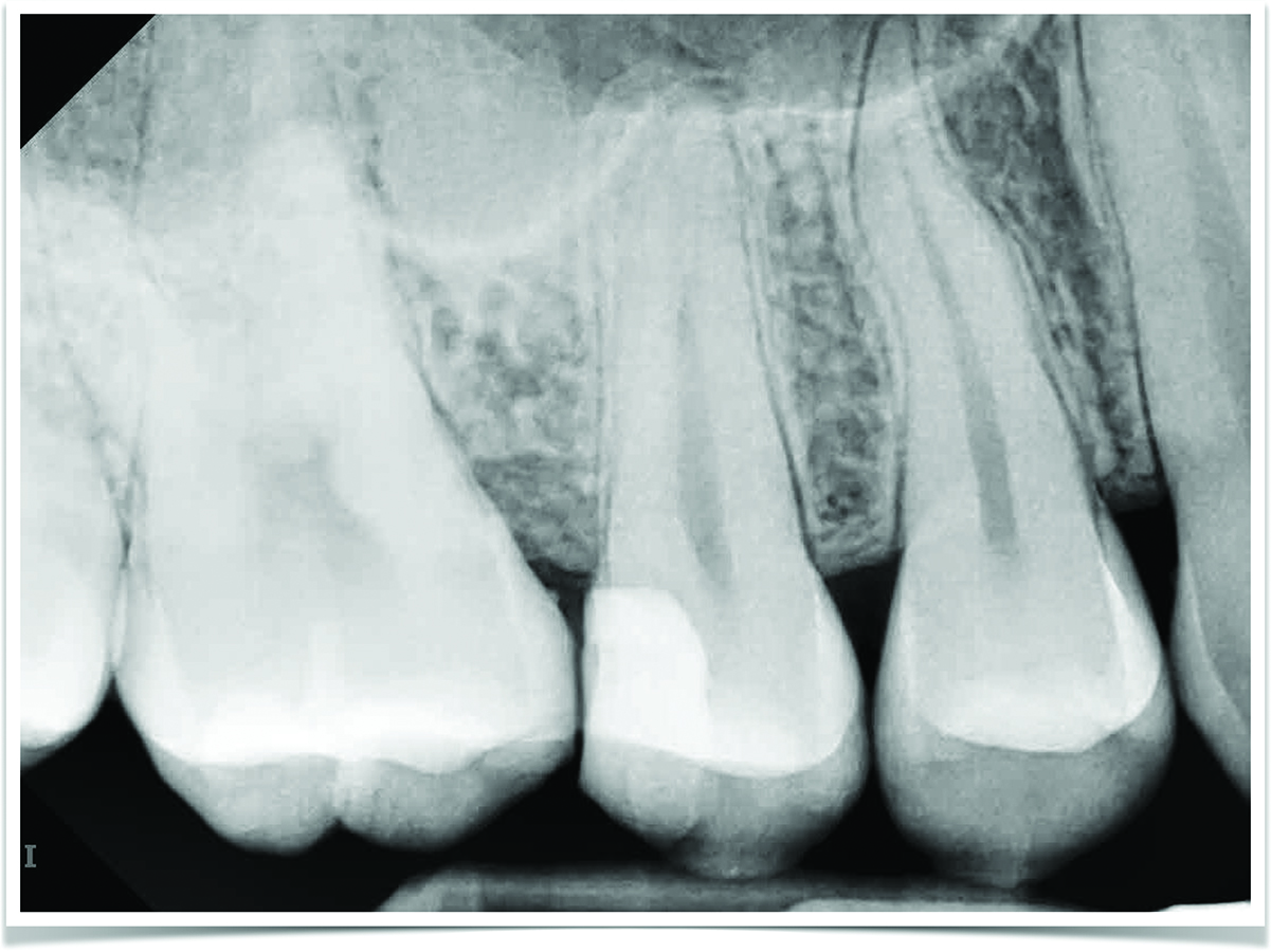Pre operative radiograph of tooth #15, only one canal negotiated with files. Symptomatic irreversible pulpitis with symptomatic apical periodontitis.