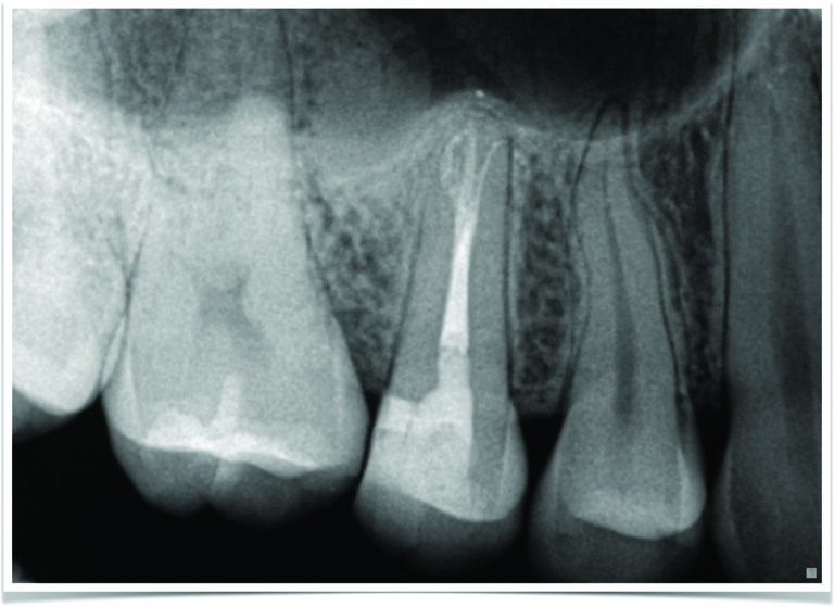 Final obturation radiograph with bonded core placed revealing trifurcation of the root canal system at the apical 1/3rd.