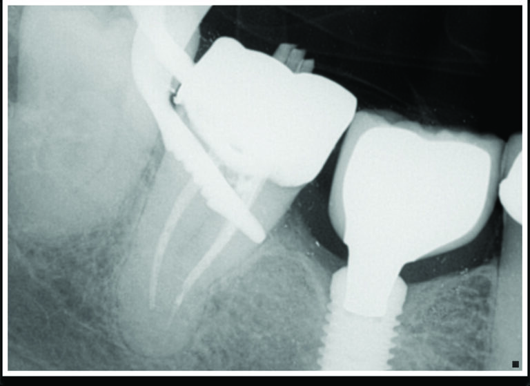 Cone fit radiograph showing canals negotiated several mm short of the apical termini.
