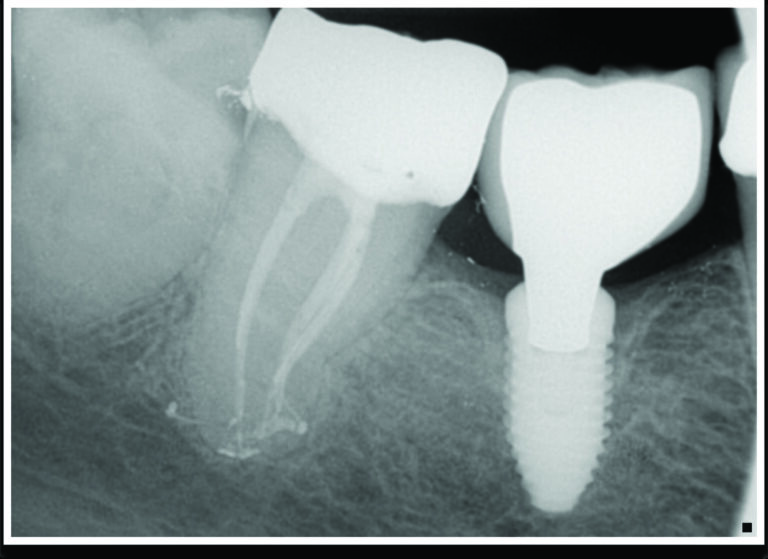 Final obturation radiograph with bonded core placed revealing “tree-like” branching’ at the apical 1/3rd of the root canal system