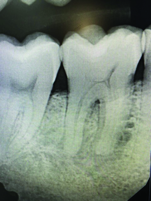 Pre-operative periapical of tooth #46. Necrotic pulp with chronic apical abcess (buccal sinus tract.)