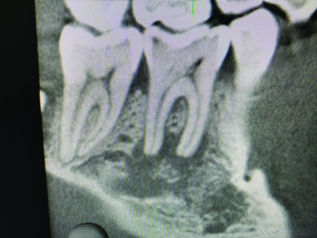 Pre-operative
CBCT of tooth #46. Sagittal view.