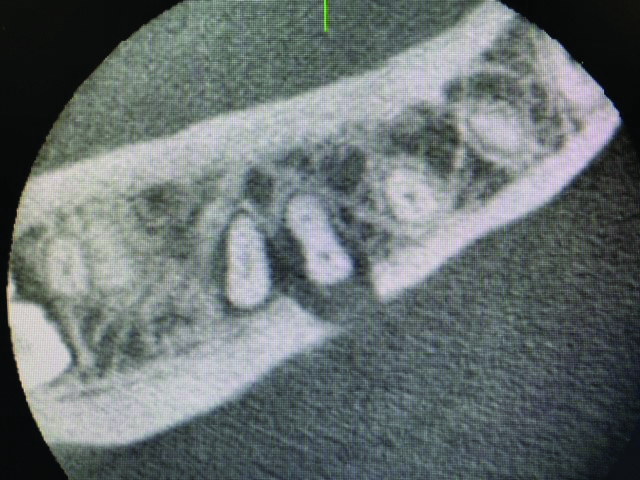 Pre-operative CBCT of tooth #46. Axial view.
