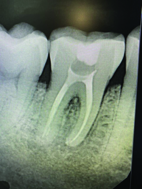 Post-operative periapical of tooth #46.
