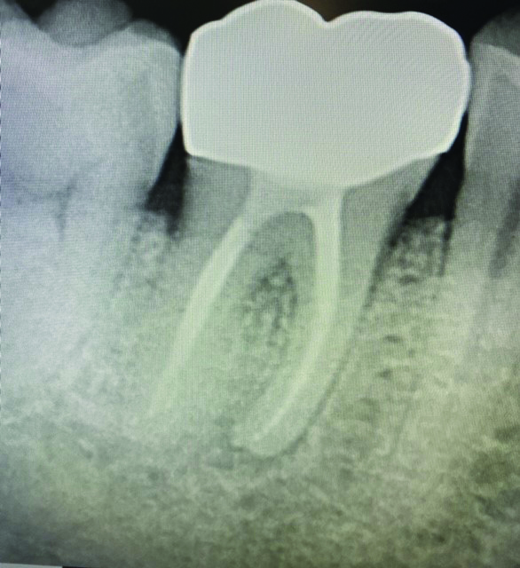 7 month recall periapical of tooth #46.