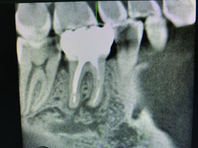 7 month recall CBCT tooth #46. Sagittal view.