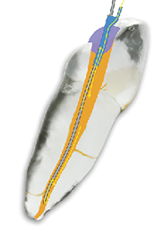 Illustration of experimental closed system EV. The irrigating canula is the vacuum source pulling the NaOCl from an IV bag through an inlet sealed into the access cavity.