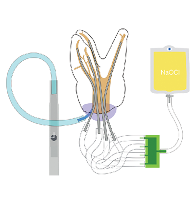 The ultimate objective for this irrigating system was to have manifolds and cannulae for each canal so multi-canalar irrigation can happen. Originally the vacuum was connected to the cannula and the irrigants inlet was placed just inside the of the access cavity.