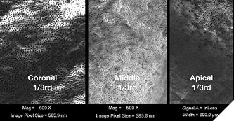 SEM imaging of root canal walls in the coronal, middle, and apical thirds (from the experimental tooth in Fig. 10) showing exceptional cleaning results (Buchanan).