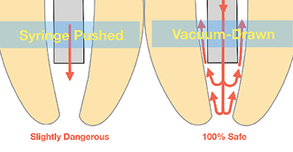 Illustration showing the safety difference between NaOCl being pushed out the end of an irrigating cannula by a syringe (the reason to only use closed-end side-vented irrigating cannulas for PPI) and NaOCl being drawn out by resident vacuum pressures. Vacuum-drawn irrigant flow ceases the moment a cannula binds circumferential canal walls.