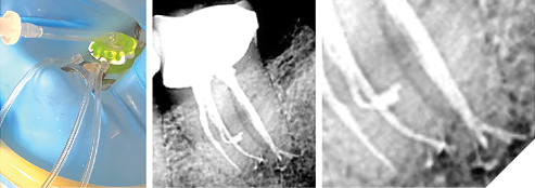 18A. Closed-System Negative Pressure Irrigation device staged on a lower molar (PulpSucker by PlanB Dental). 18B. Post-op radiograph showing a 7mm long mid-mesial canal that was never touched with a file but was cleaned of vital tissue. 18C. Close-up shows an apical delta system of lateral canals in the apical third of the distal canal.