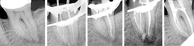 19A. Recent clinical case that presented with severe irreversible pulpitis. 19B. Cone fit radiograph, after PulpSucker irrigation in a single-visit procedure, showing perfect cone fit in the mesial canals, but inadequate cone fitting in the very complex distal canal. 19C. Multiple impediments at the end of the virtually non-instrumented distal canal were the ideal indication for carrier-based obturation. 19D. Post-obturation image shows a loop off the distal canal that is hidden in all the other radiographs. 19E. A post-operative radiograph showing the independent MIE access entries for mesial and distal canals and the multiplicity of lateral canals in both roots.