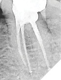 This tooth continued to refer pain (in the endodontic zone) to its owner for 18 months after RCT. Two different endodontists recommended apicoectomy to remove the overextended filling material beyond the MB and D roots. Instead the patient was told the case could be cut at any time in the future, but that surgery might be avoided by simply retreating the underfilled ML canal.