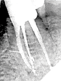 Post-op
radiography revealed a mid-mesial canal with its own blood supply.