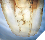 Cleared mesial root of an extracted lower molar illustrates the impossibility of cleaning this root canal system with instruments and the necessity of irrigating effectively.