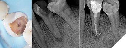 20AB. Pre-op. situation showing sever broken down lower left premolar with a partial necrosis of the pulp. 20C. Post-op. image showing complete obturation of the apical pulp space and delta after PulpSucker irrigation in a single-visit treatment. Immediate placement of a fibrepost was done for future indirect restoration.