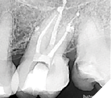 This MIE RCT was cleaned with conventional positive pressure irrigation with 6% NaOCl, delivered with a 12cc syringe and a 30 Ga. closed-end side-vented cannula. Simple, inexpensive, but uni-canular and very time dependent (20-40 mins).