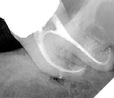 The lower molar RCT was treated by Filippo Santarcangelo using EndoVac by Kerr Endodontics. This tooth was irrigated continuously for 45 minutes because he could not negotiate the last 3mm of the distal canal. Post-op radiography reveals the distal primary canal cleaned and filled 3mm beyond the apical extent of instrumentation with multiple microscopic lateral canals filled in both roots.