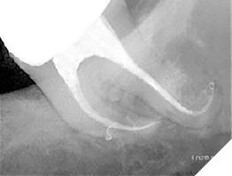 The complete healing seen at the 4-month recall is testament to the thoroughness of the irrigation. Like conventional irrigation, EndoVac is uni-canular, but completely safe due to the cannula being used for suction instead of irrigants delivery.