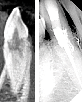Lower cuspid with extensive internal resorption treated with GentleWave® irrigation. Note the myriad of resorptive lacuna trails filled post-operatively after the vital tissue causing them was dissolved during two complete cycles of GW (Case by Buchanan).