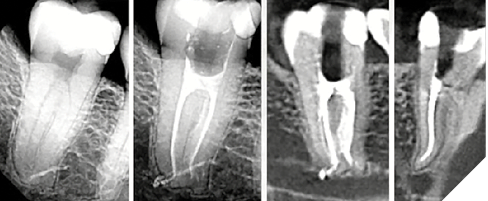 This lower C-shaped molar presented with a severely inflamed pulp. 5B. Post-op radiographs show abrupt mesial and distal apical canal curvatures as well as significant isthmus morphology. 5C. Extending toward the centreline from MB and D primary canals. 5D. This CBCT view shows the MB canal possibly treated short of terminal length.