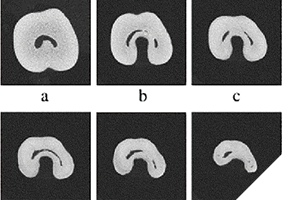 Axial CBCT views, originally published in: Fan B, Cheung GSP, Fan M, Gutmann JL, Bian Z. C-shaped canal systems In mandibular second molars: part 1- Anatomical features.