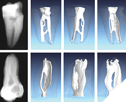 J Endod. 2004 Dec; 30(12): 899-903) and computer reconstructions. Originally published in Solomon M, Piqué F, Fan B, Eilat Y, Berman LH. The challenge of C-shaped canal systems: A comparative study of the Self-Adjusting File and ProTaper. J Endod. 2012 Feb; 38(2): 209-214) of C-shaped molars, showing isthmus spaces extending from MB to D canals. Generally impossible to instrument, some of these isthmus spaces are wider than 5mm’s presenting the ultimate challenge to any irrigation procedure.