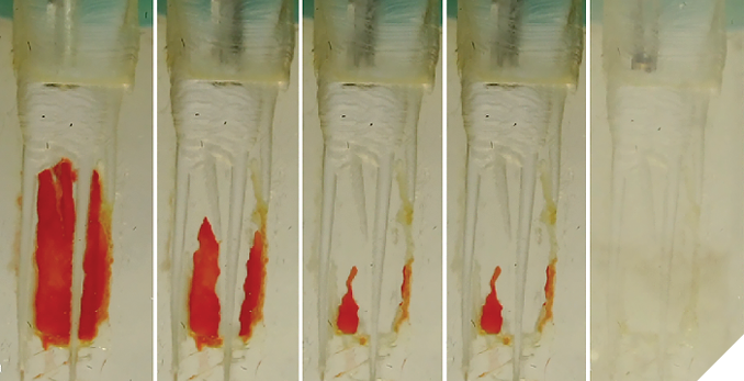 8A. Isthmus research block after the 30-second distilled water cycle–no pulp replica dissolved. 8B. The block after 2.5 minutes of the NaOCl cycle. 8C. The block after the end of the 5-minute NaOCl cycle. 8D. The block after the 2-minutes EDTA cycle. 8E. Another GW procedure instrument was installed in the console and after an additional 2.5 minutes of the NaOCl cycle all remaining tissue was gone, revealing that although GW greatly accelerates NaoCl tissue dissolution, it is still a linear process needing adequate time to do its job.comparative study of the Self-Adjusting File and ProTaper. J Endod. 2012 Feb; 38(2): 209-214) of C-shaped molars, showing isthmus spaces extending from MB to D canals. Generally impossible to instrument, some of these isthmus spaces are wider than 5mm’s presenting the ultimate challenge to any irrigation procedure.