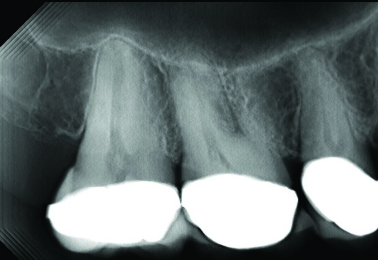 The magnet attachment locks in a known distance from the X-ray source to the sensor. This allows the computer algorithm to generate an image stack for visualization through the teeth. 3A shows the palatal root of the first molar with no evidence of pathology.