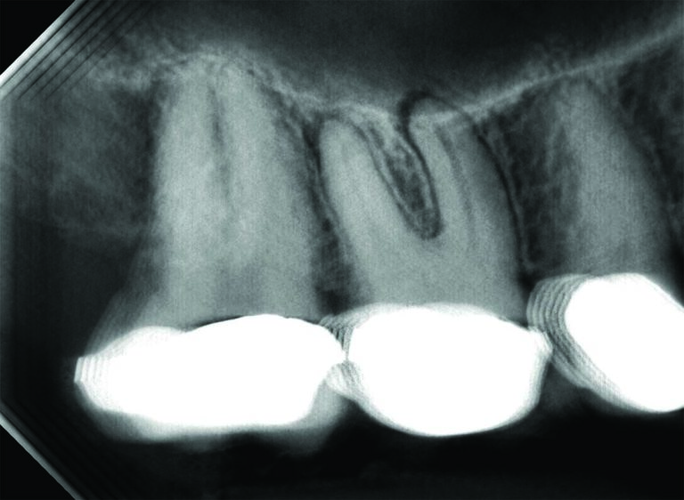 3B demonstrates well-defined radiolucencies at the same first molar’s MB and DB root ends. Note the palatal root is not visible in this section.