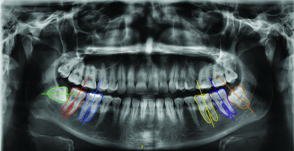 Automatic segmentation of molars and subsequent calculation of angulation between the third molar and its neighboring teeth to estimate eruption potential (developed by Vranckx et al. in collaboration with Relu, Leuven, Belgium). 3. Fully automatic 3D model segmentation using CBCT imaging (Relu, Leuven, Belgium).