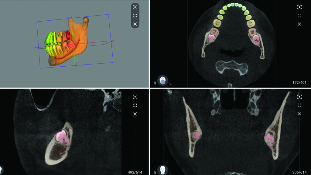 Fully automatic 3D model segmentation using CBCT imaging (Relu, Leuven, Belgium).