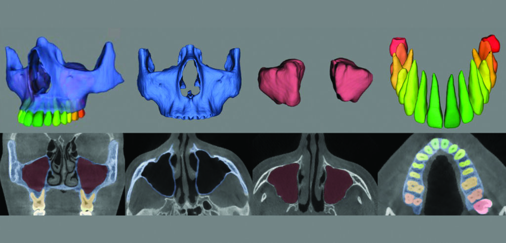 Virtual patient creator by Relu (Leuven, Belgium). This cloud-based platform automatically segments dentomaxillofacial CBCT imaging datasets in to customizable 3D models that can be used for virtual surgical planning and CADCAM applications.