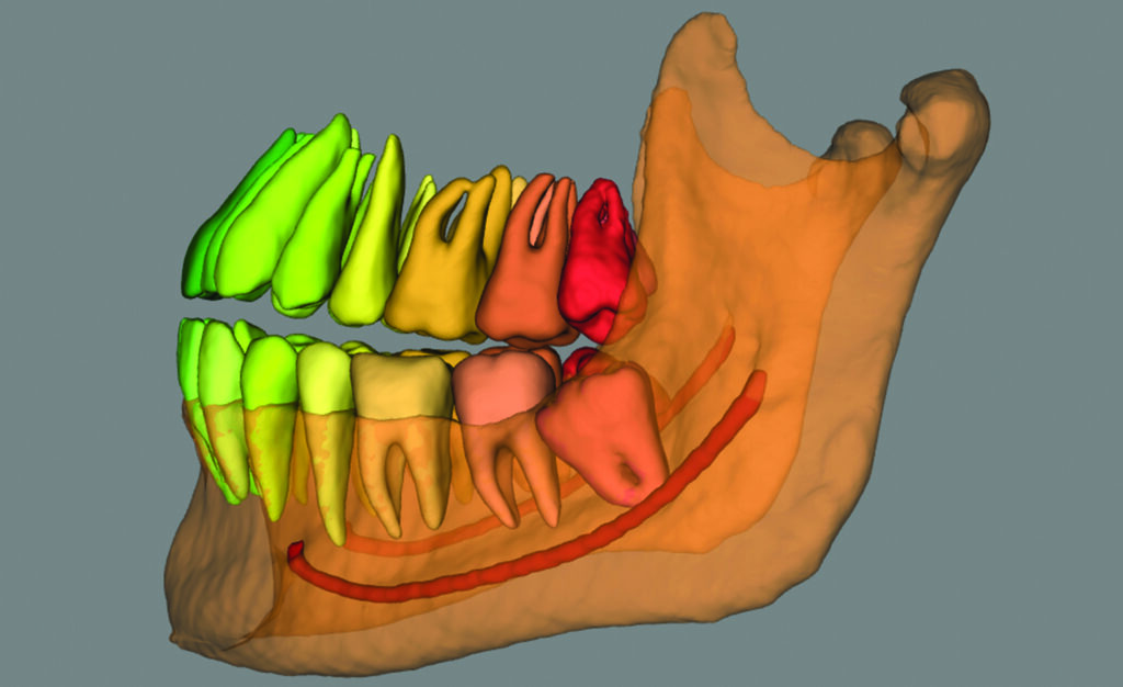 An automatically created 3D model (Virtual patient creator, Relu, Leuven, Belgium) indicating the third molar and mandibular canal relationship.