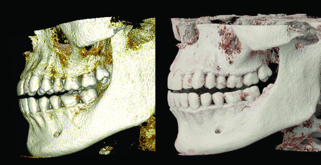 Comparison of a volume rendered model based on CBCT imaging (left) versus a cinematically rendered model based on the same CBCT dicom dataset (right).