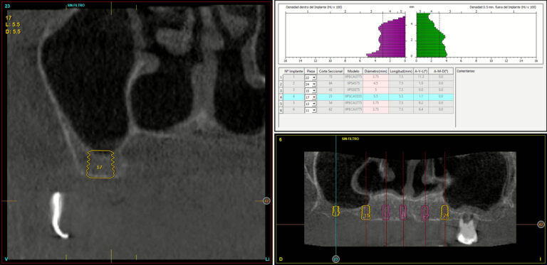Diagnostic computerized axial tomography (CAT) scan of the immediate loading extra-short implant to be placed.
