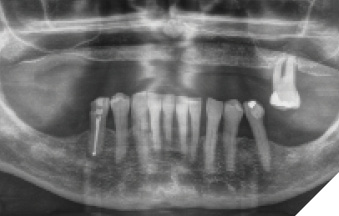 Initial x-ray image. The patient attends the clinic seeking an implant-supported rehabilitation. The low residual bone volume can be observed in the X-ray in the vertical area of the upper maxilla, which is more pronounced in the posterior areas.