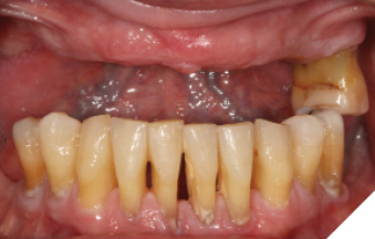Intra-oral image of the patient without prosthesis and with a removable prosthesis.