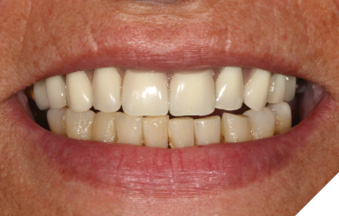 Intra-oral image of the patient without prosthesis and with a removable prosthesis.