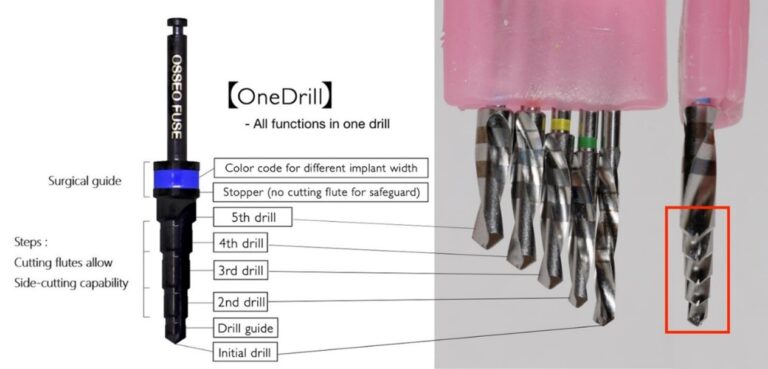 1. A high-efficiency fluted, lateral-cutting drill specifically designed for rapid implant placement features many characteristics that promote accurate placement and primary stability. 2. The basic concept of the Onedrill™ one drill implant system is incorporating the traditional sequence of multiple drills from narrow to wide (center image) into a singular OsseoFuse® step drill (left image); a 90-degree rotation of the conventional multiple drill system (right side) is shown for comparison.